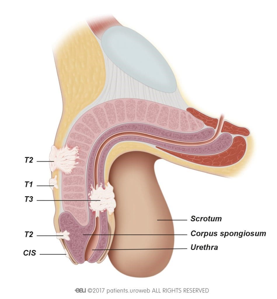 سرطان آلت تناسلی (Penile Cancer) چیست؟