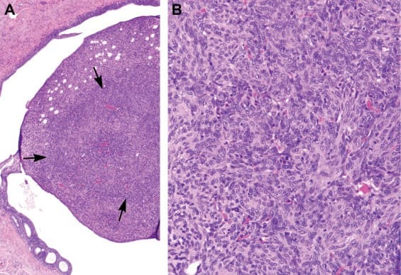 سارکوم استرومایی آندومتر (Endometrial stromal sarcoma یا ESS)