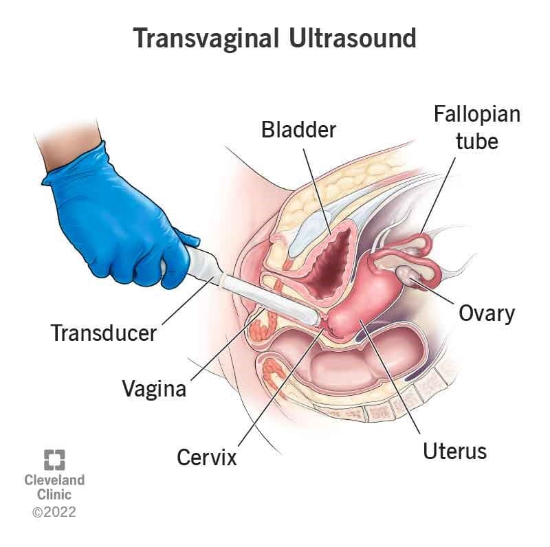 سونوگرافی ترانس واژینال (Transvaginal ultrasound)