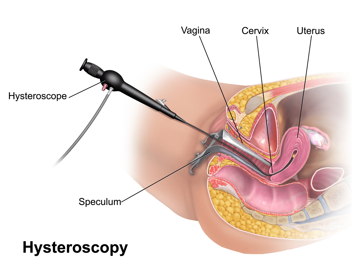 هیستروسکوپی (Hysteroscopy)