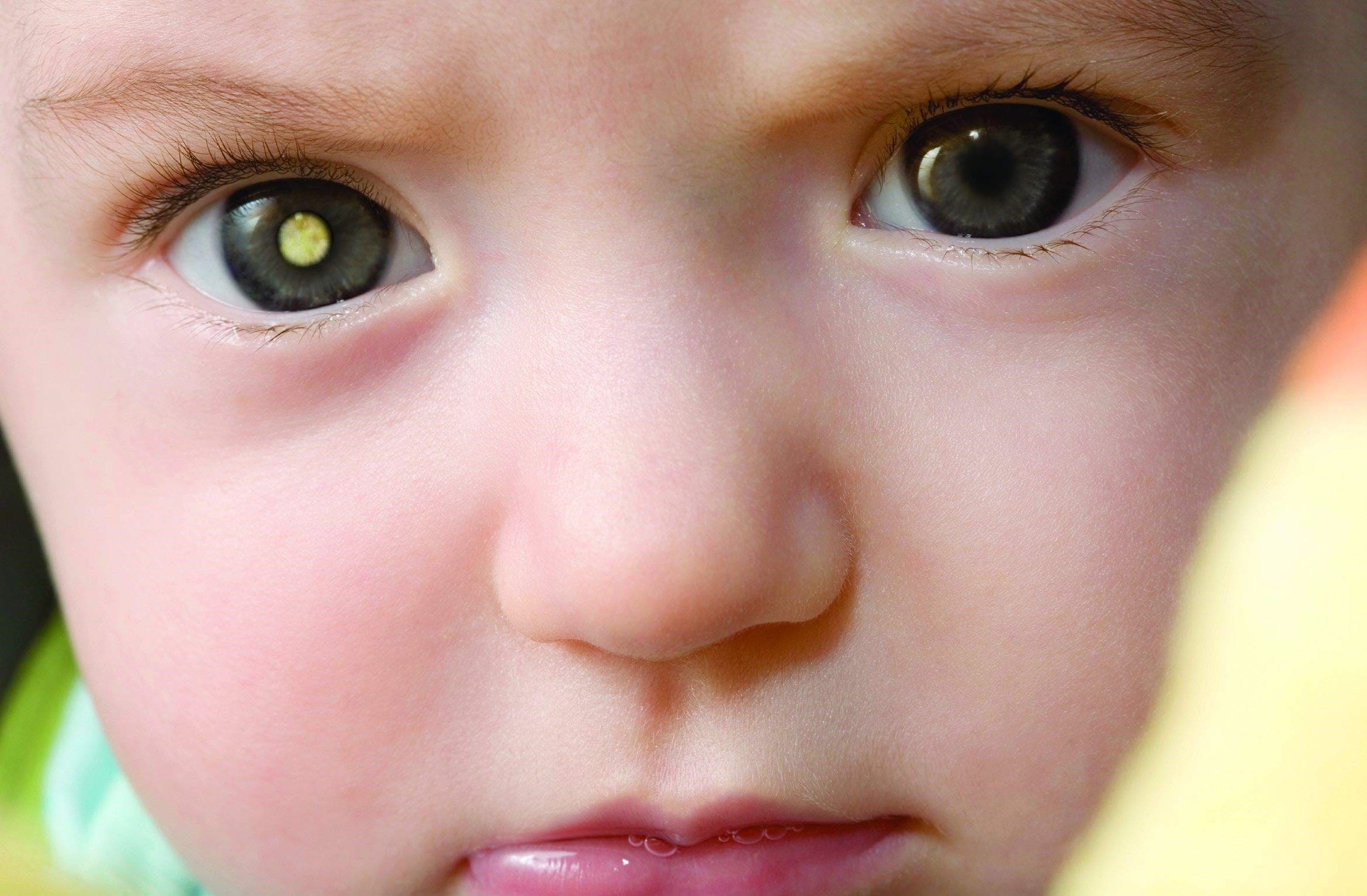 رتینوبلاستوما مادرزادی (ارثی) یا Congenital retinoblastoma