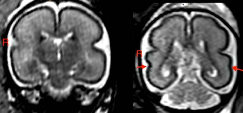 mri brain
