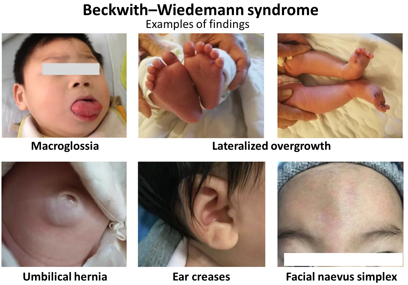 سندرم بکویث ویدمن (Beckwith-Wiedemann syndrome)