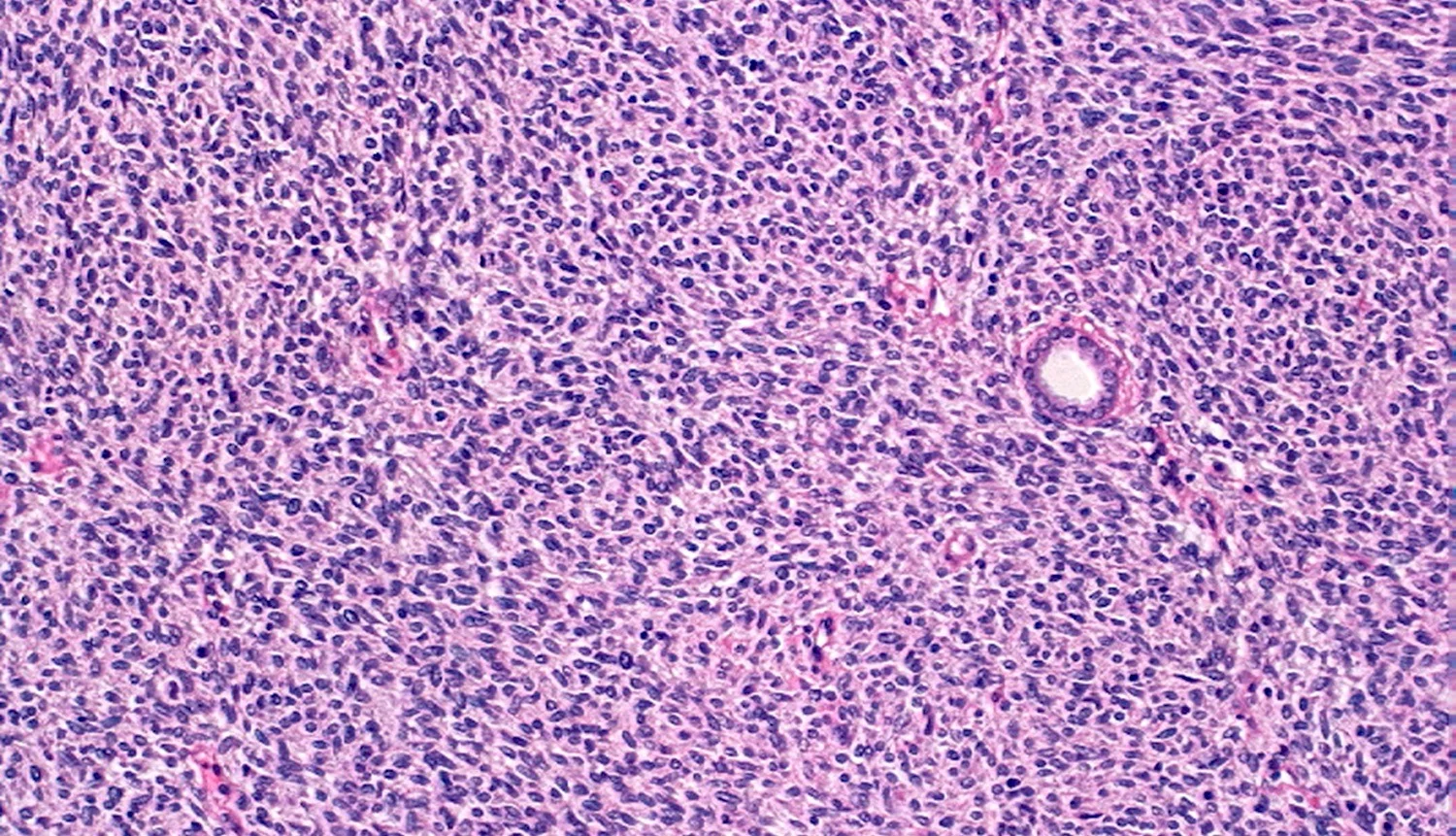 نفروم مزوبلاستیک