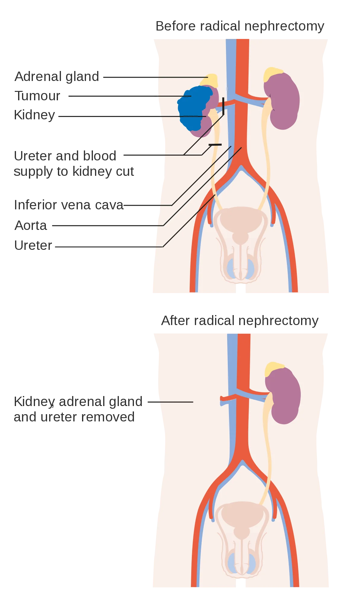 نفرکتومی رادیکال (Radical nephrectomy)