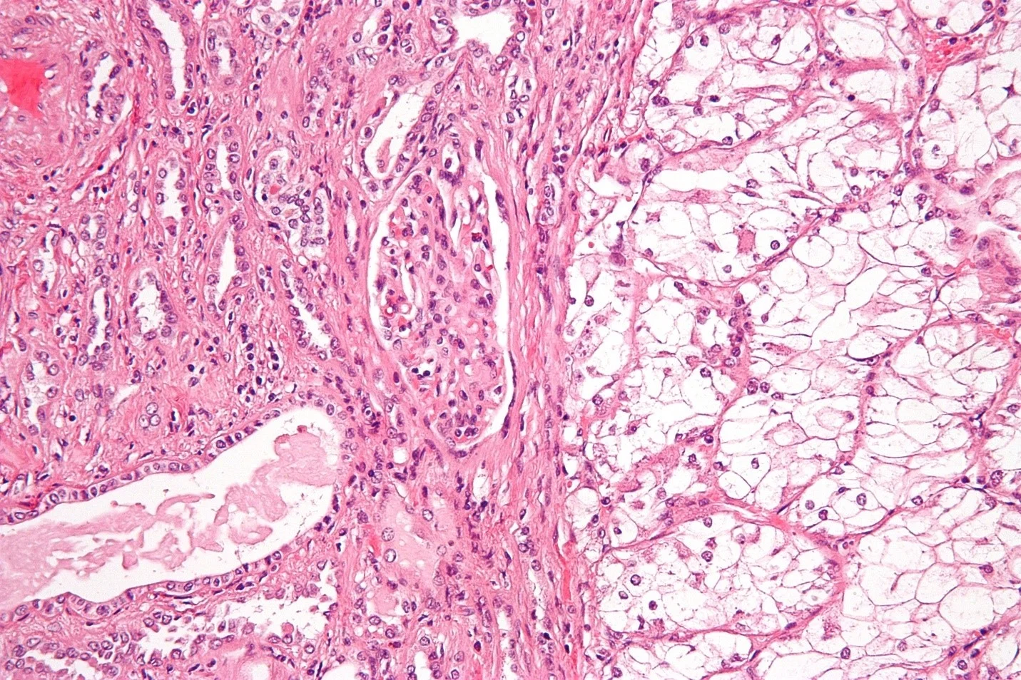 کارسینوم سلول کلیه (Renal cell carcinoma)