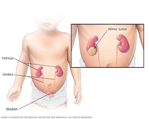 تومور ویلمز (Wilms Tumors) چیست؟