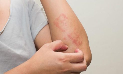 لیکن پلان چیست؟ انواع، علائم تشخیص و درمان