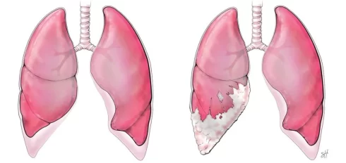 مزوتلیومای بدخیم چیست؟ تعریف، علائم، پیشگیری و درمان