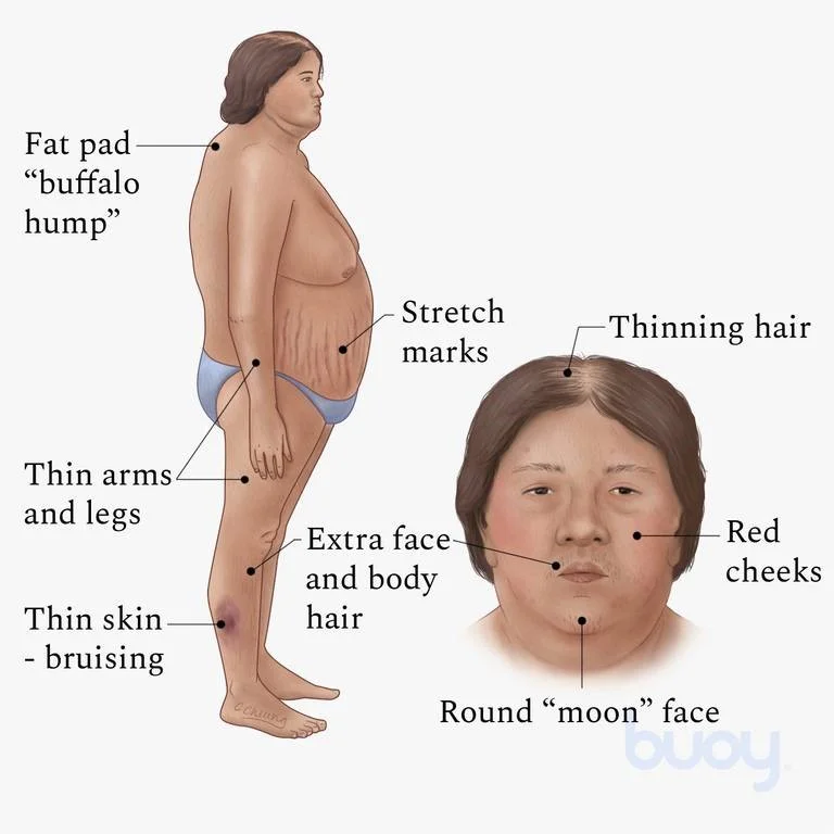 تظاهرات سندرم کوشینگ