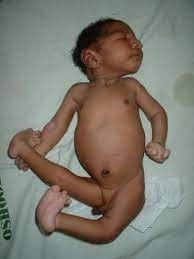 ویژگی های بالینی تریزومی 18