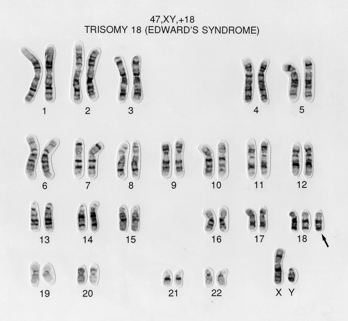 کاریوتایپ تریزومی 18