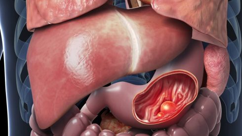 تومور کارسینوئید دستگاه گوارش