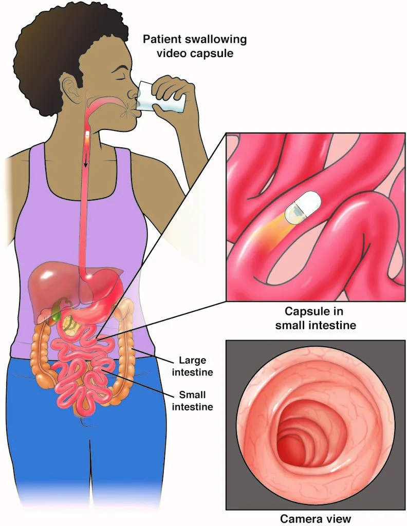 آندوسکوپی کپسولی