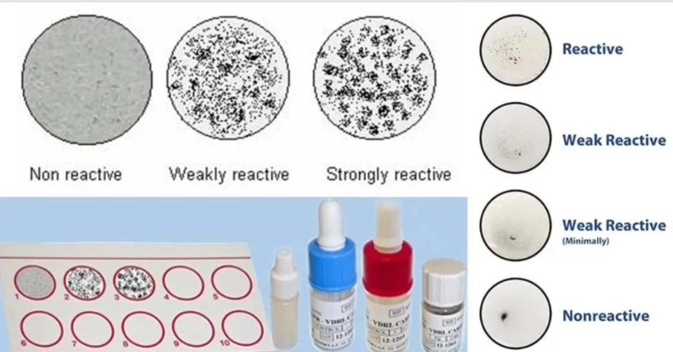 تفسیر نتایج آزمایش VDRL