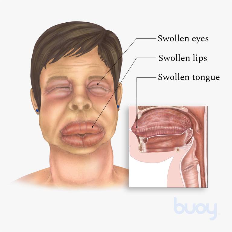 آنژیوادم (Angioedema) چیست