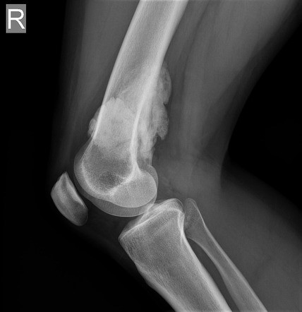 استئوسارکوم