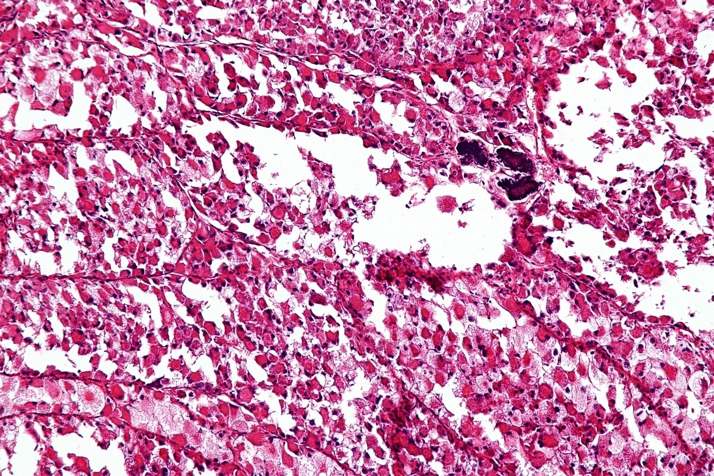 انواع سارکوم بافت نرم