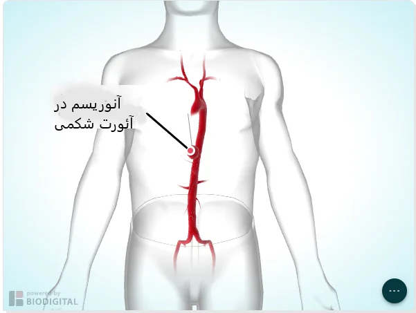 آنوریسم آئورت شکمی