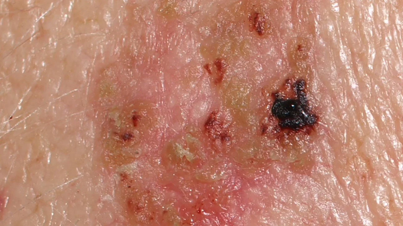 کارسینوم سلول سنگفرشی درجا