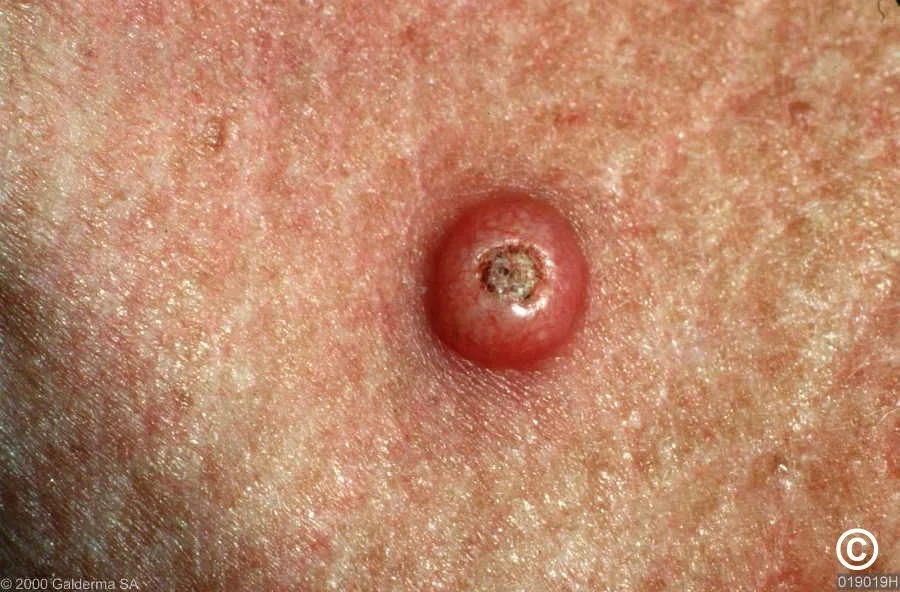 کراتوآکانتوما