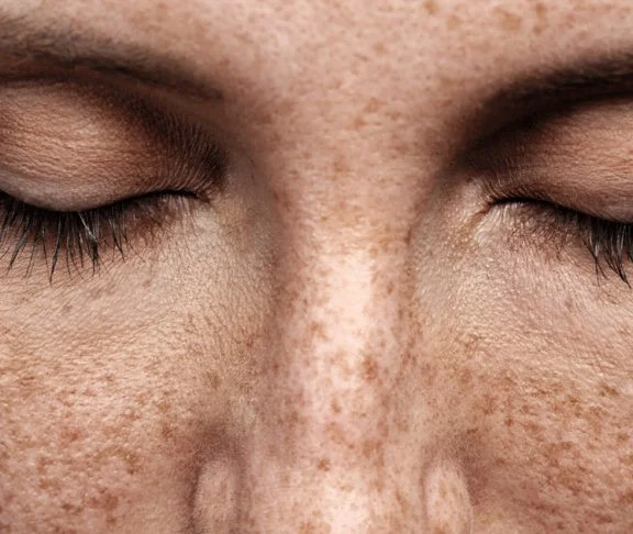 زیرادرما پیگمنتوزوم