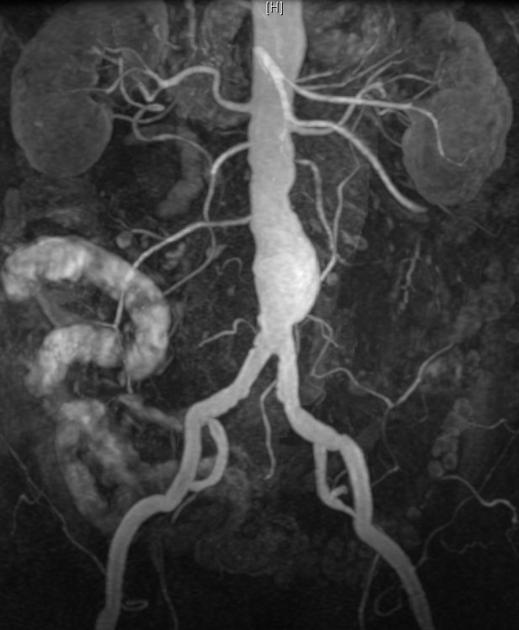 اسکن mri آنوریسم