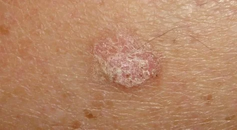 کراتوز اکتینیک