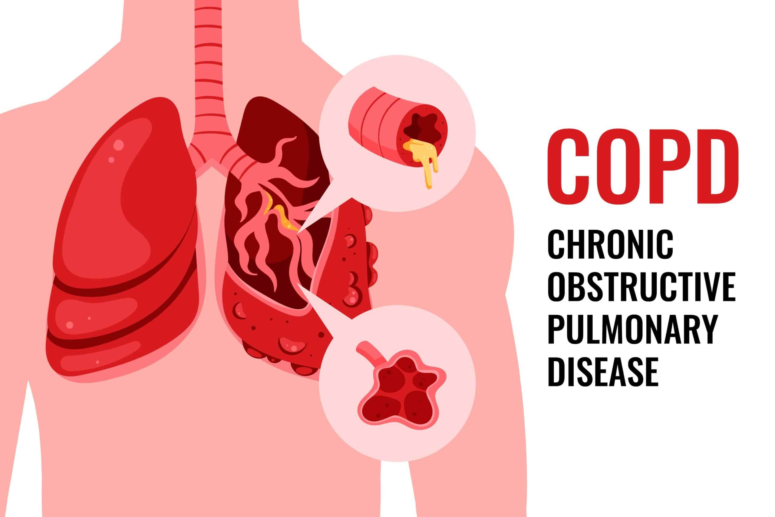 عفونت‌های دستگاه تنفسی copd