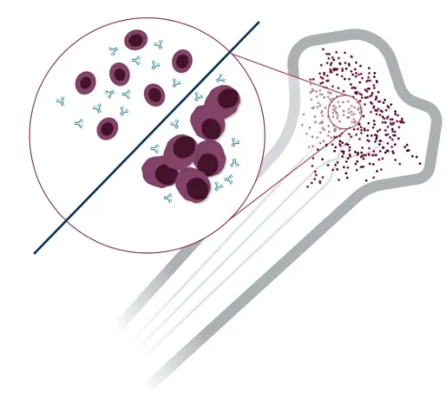 مولتیپل میلوما
