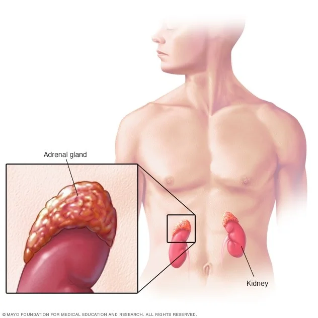نوروبلاستوما (Neuroblastoma) چیست