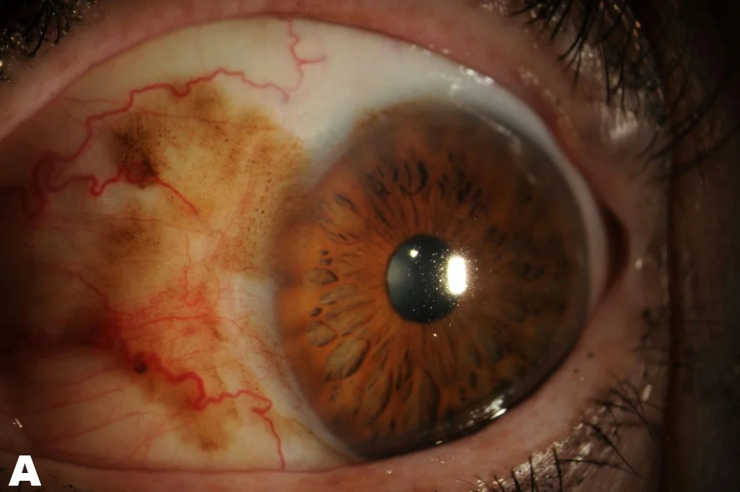 انواع مختلف خال (nevi) در چشم 