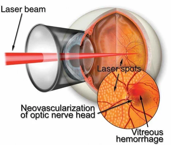 فتوکواگولاسیون لیزری 