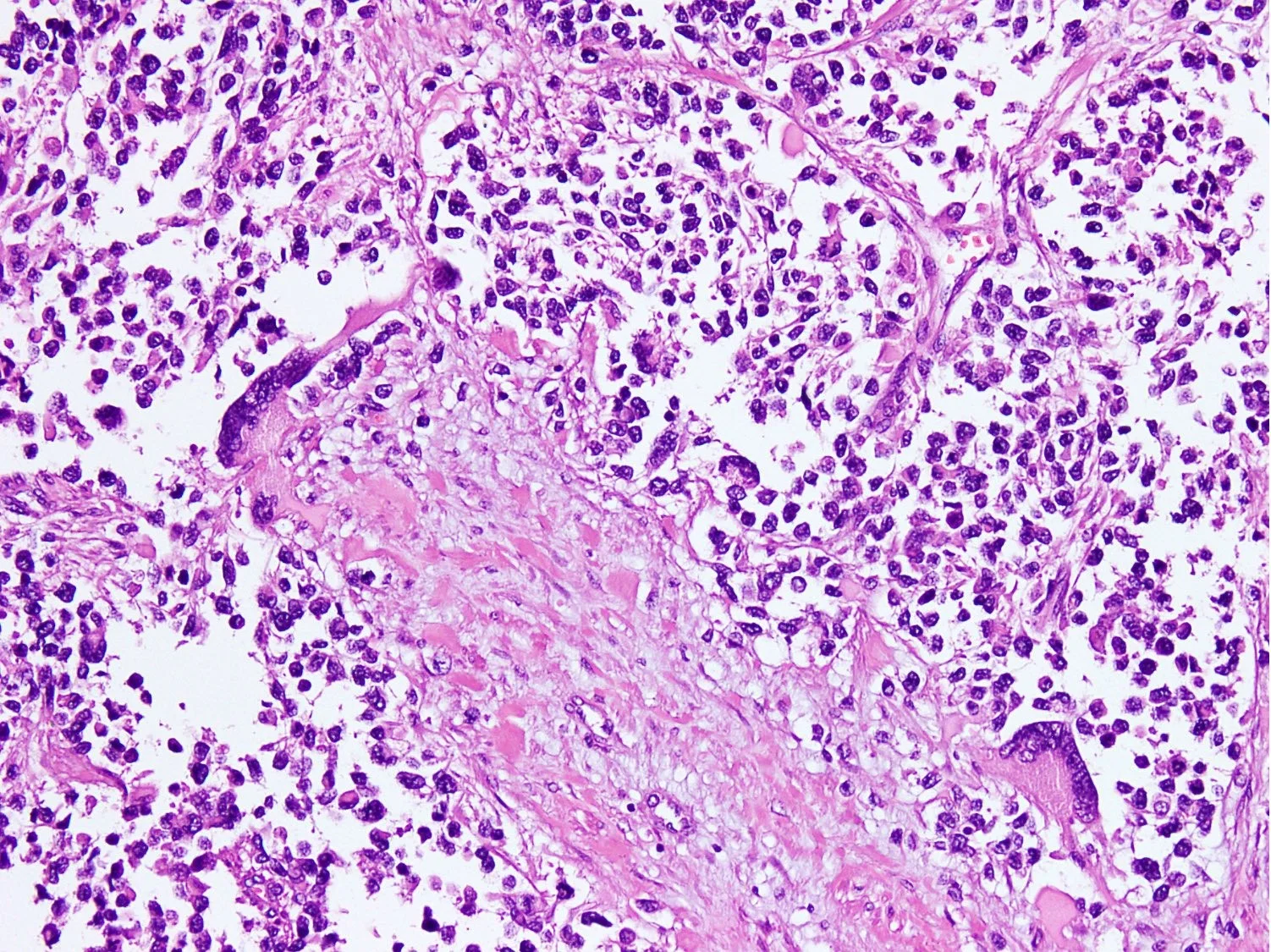 رابدومیوسارکوم آلوئولار 