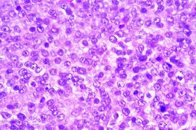 رابدومیوسارکوم آناپلاستیک