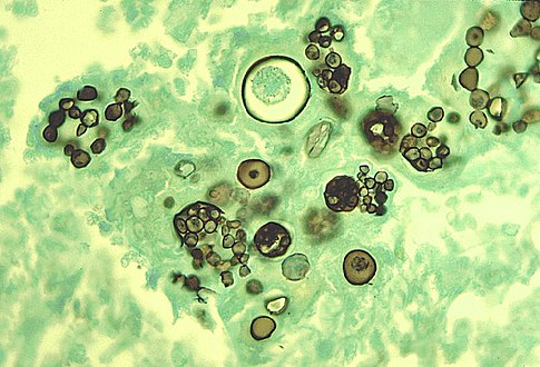 Coccidioidomycosis