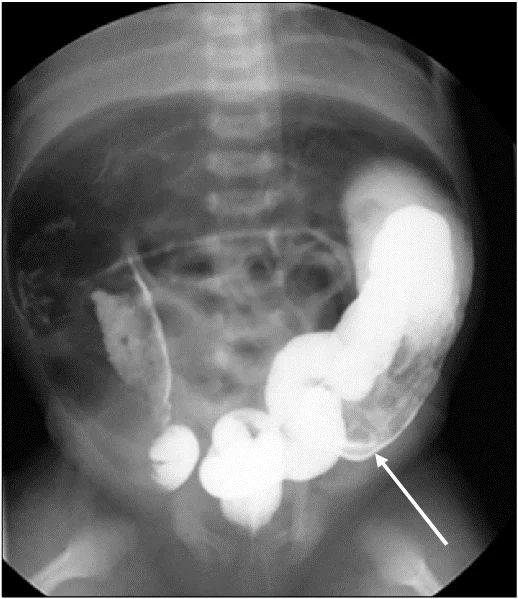 علل بیماری هیرشپرونگ