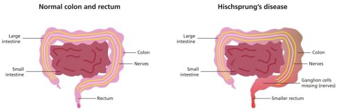 بیماری هیرشپرونگ