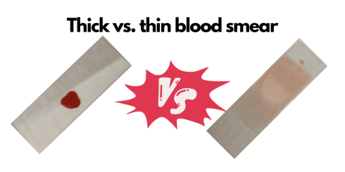 تفاوت اسمیر خون ضخیم و اسمیر خون نازک