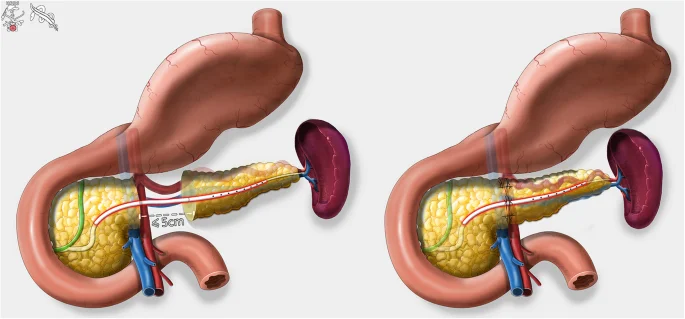 پانکراتکتومی مرکزی