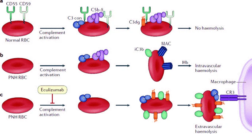 هموگلوبینوری پاروکسیسمال شبانه