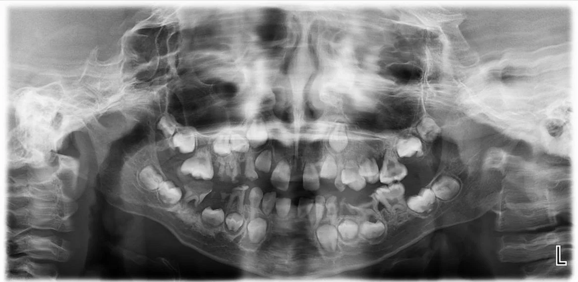 تشخیص سندرم Singleton-Merten