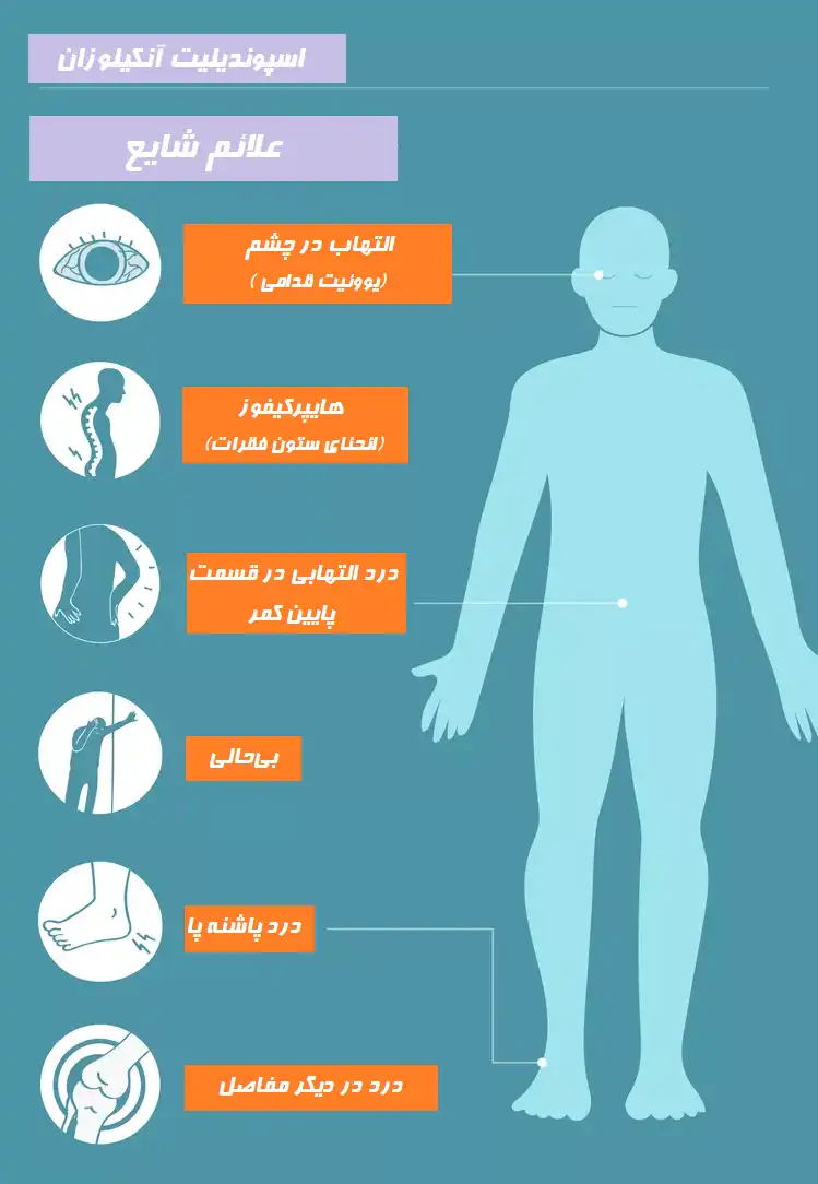 علائم اسپوندیلیت آنکیلوزان