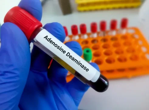 آزمایش آدنوزین دآمیناز (ADA) چیست؟ تفسیر نتایج آزمایش ADA