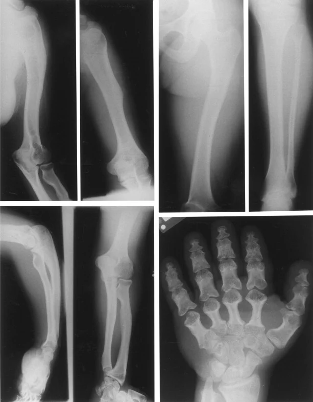 علائم و نشانه‌های دیسپلازی آکرومزوملیک