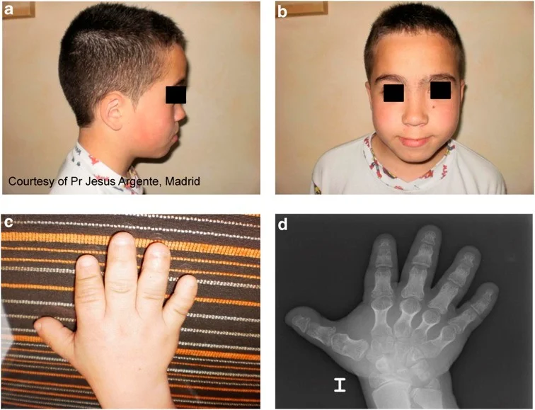 دیسپلازی آکرومزوملیک علل