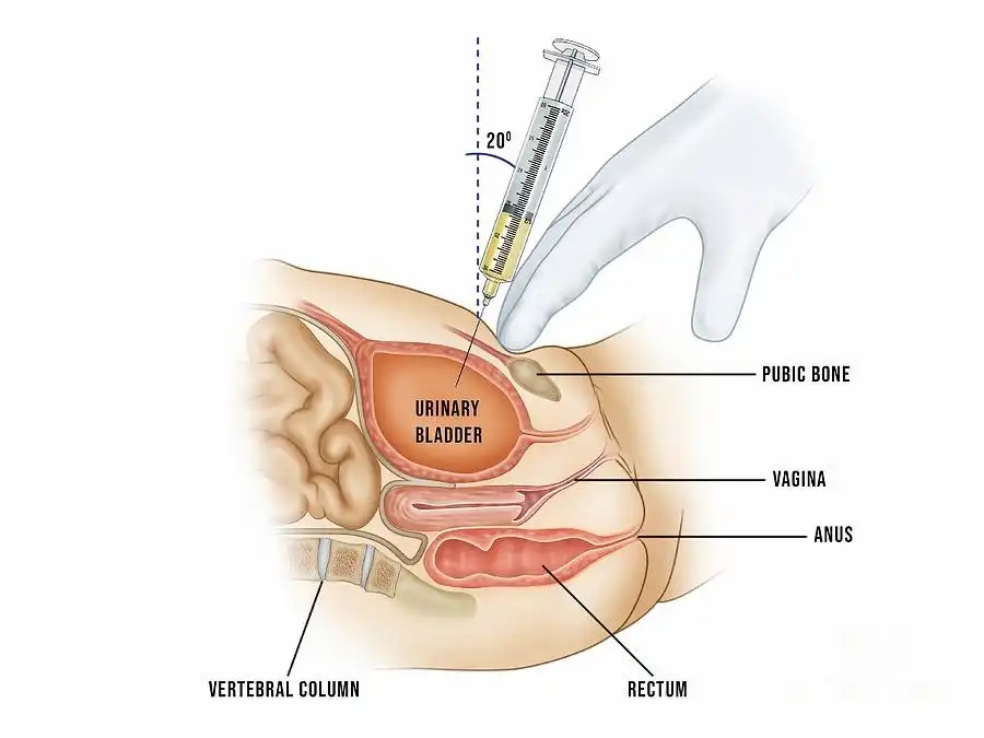 پونکسیون سوپراپوبیک