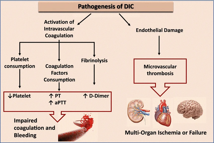 انعقاد منتشر داخل عروقی (DIC)