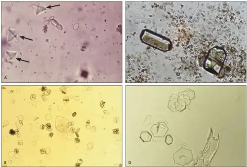 آنالیز میکروسکوپی ادرار