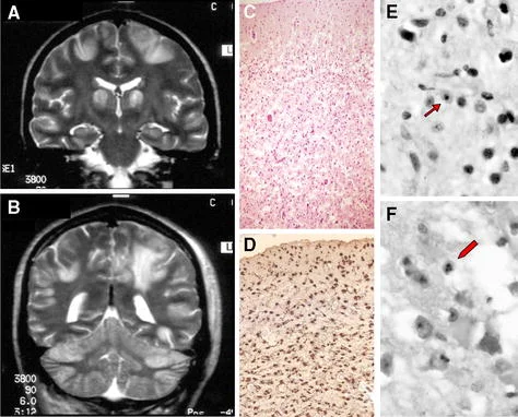 علل بیماری ‌آلپرز